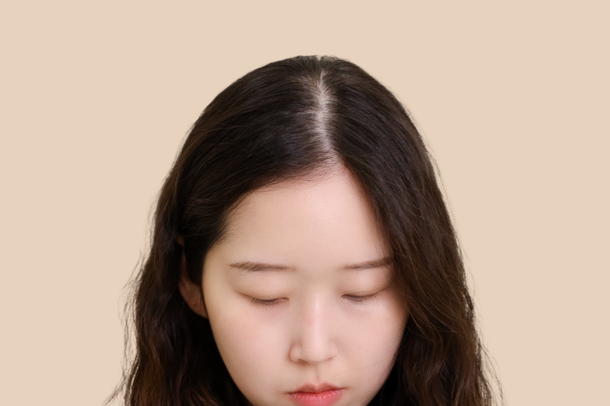 여성 두피문신 시술 전