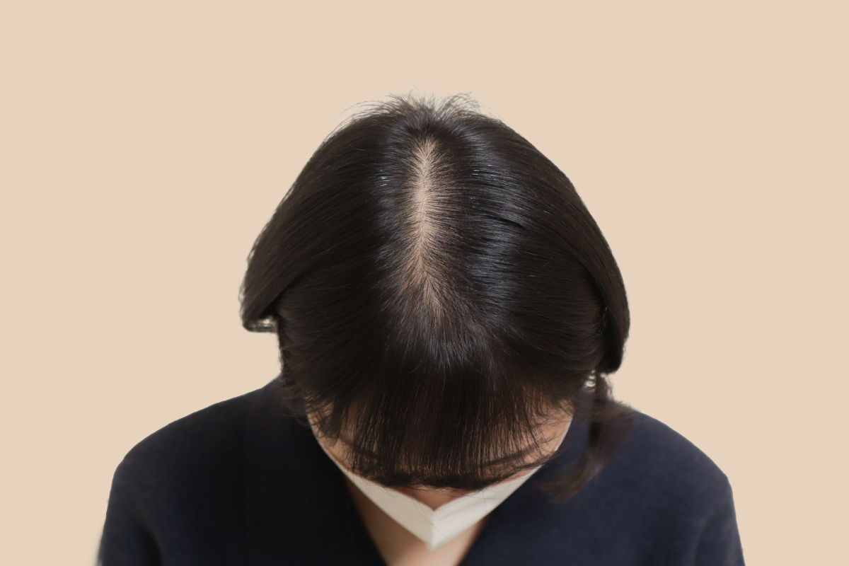 여성 두피문신 시술 전