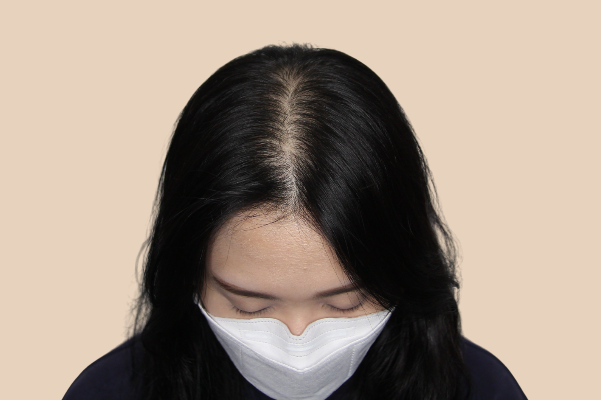 여성 두피문신 시술 전