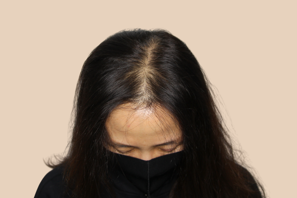 여성 두피문신 시술 전