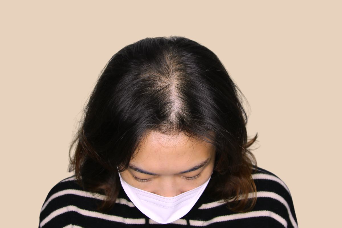 여성 두피문신 시술 전