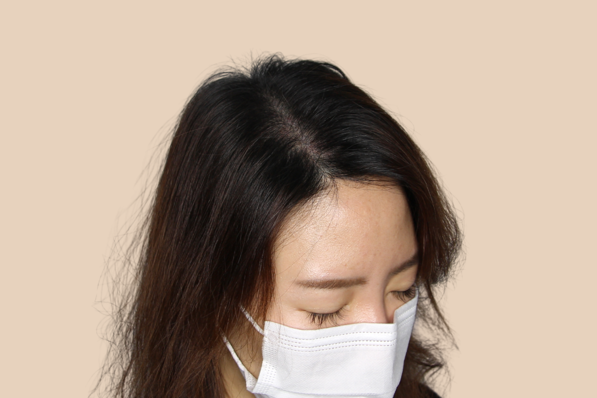 여성 두피문신 시술 전